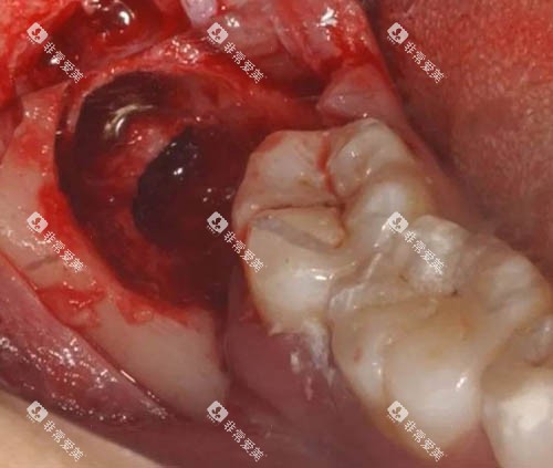 拔牙手术细节图