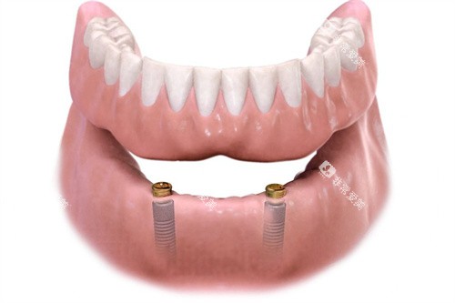 种植覆盖义齿Locator呈现图