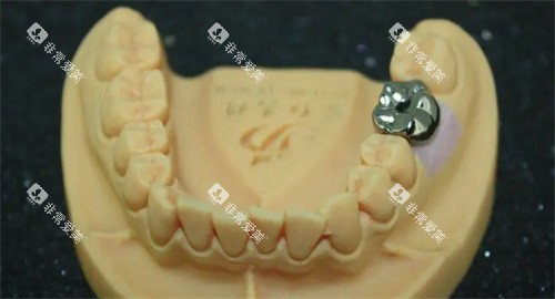 纯钛一体冠 纯钛一体冠