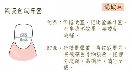 陶瓷自锁牙套