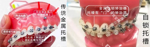 牙齿矫正牙套对比实物展示图