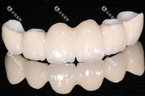 假牙半口展示图 假牙半口展示图