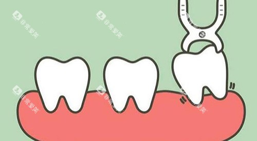 拔牙改善展示图照片 拔牙改善展示图照片