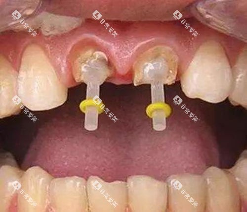 牙齿打桩示意图 牙齿打桩示意图