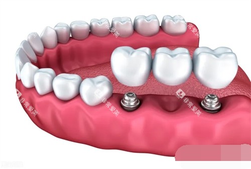 两颗种植牙安装联排牙冠漫画示意图 两颗种植牙安装联排牙冠漫画示意图