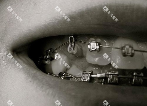 牙齿矫正牙套金属托槽牙套 牙齿矫正牙套金属托槽牙套