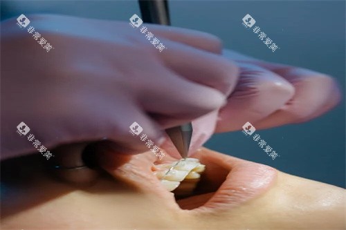 牙齿矫正操作中 牙齿矫正操作中