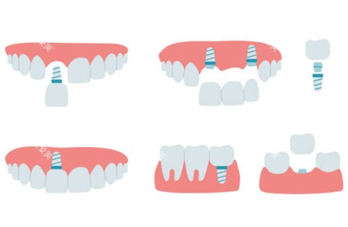 牙齿缺失种植牙示意图 牙齿缺失种植牙示意图