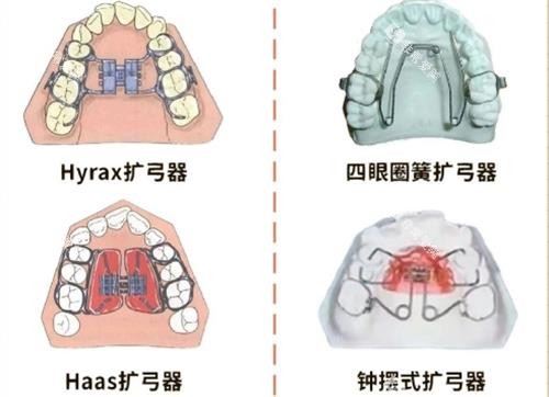 扩弓器的种类