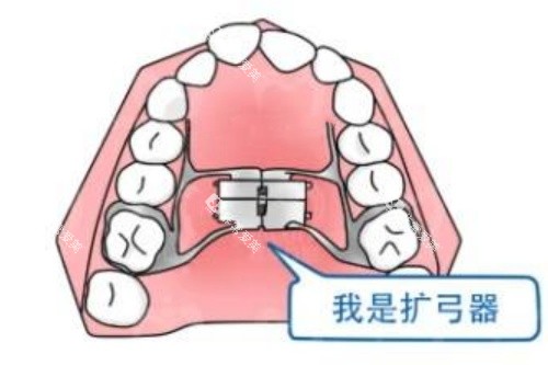 正畸扩弓示意图