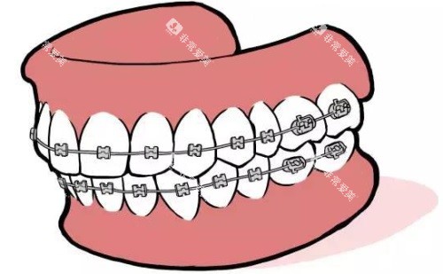 金属固定矫正示意图 金属固定矫正示意图