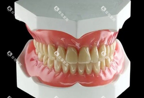活动假牙示意图 活动假牙示意图