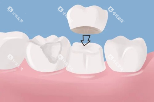 镶牙卡通图片展示 镶牙卡通图片展示
