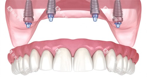 ALL ON 4 61 ALL ON 4 61