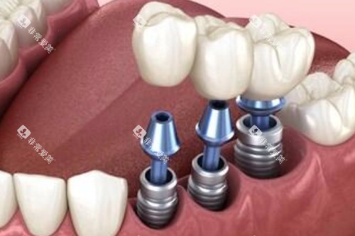 种植牙卡通图展示 种植牙卡通图展示