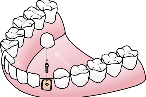 种植牙安装牙冠卡通图 种植牙安装牙冠卡通图