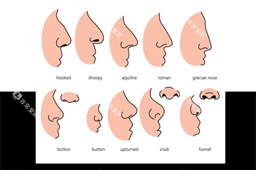 鹰钩鼻和朝天鼻矫正