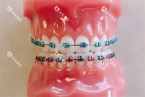 金属托槽矫正模型正向图