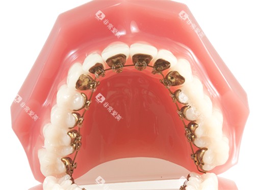 牙齿矫正金属舌侧矫正牙套模型