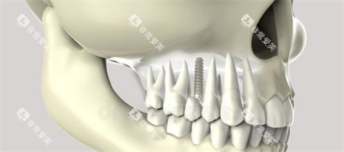 种植牙动画图示展示 种植牙动画图示展示