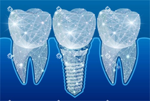 种植牙科技感卡通 种植牙科技感卡通