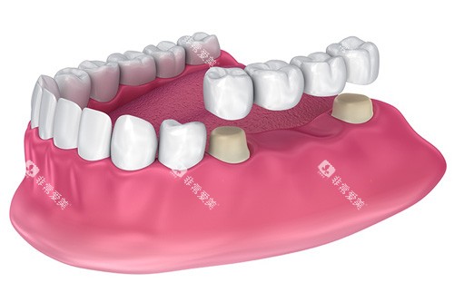 全瓷牙冠义齿修复示意图 全瓷牙冠义齿修复示意图