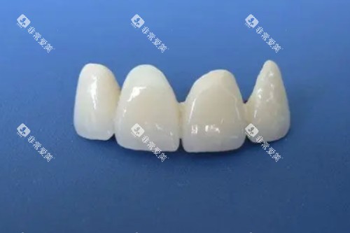 全瓷牙模型展示图 全瓷牙模型展示图