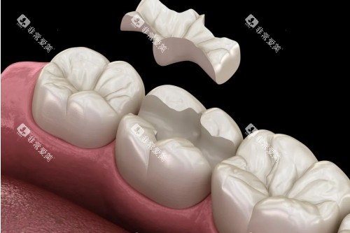嵌体补牙卡通图 嵌体补牙卡通图
