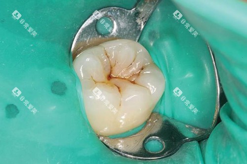 橡皮障补牙 橡皮障补牙