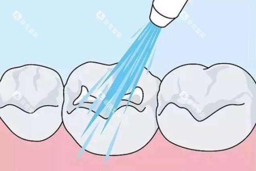 儿牙涂氟卡通图 儿牙涂氟卡通图