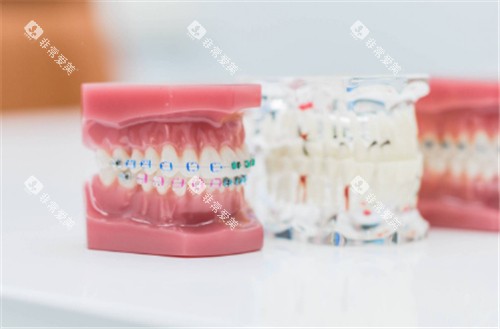 牙套模型图示