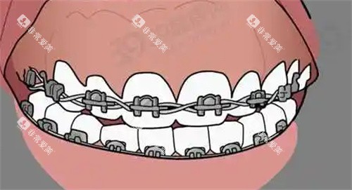 牙齿矫正动画图 牙齿矫正动画图