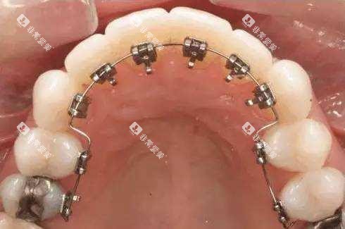 牙齿矫正舌侧矫正 牙齿矫正舌侧矫正
