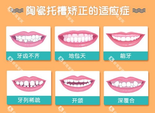 陶瓷半隐形矫正适应症