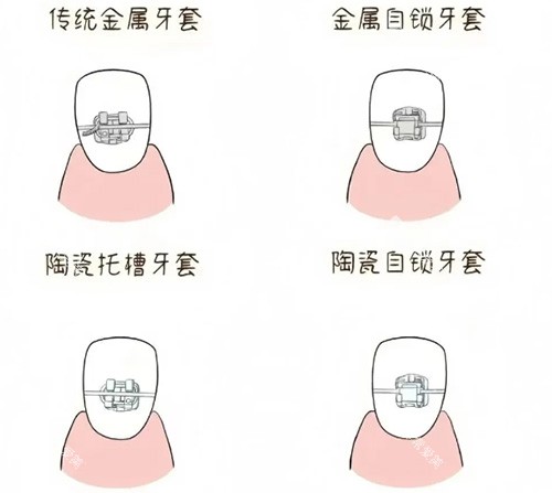 牙套品牌种类示意图