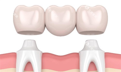 牙冠三联桥 牙冠三联桥