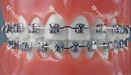金属牙套示意图 金属牙套示意图