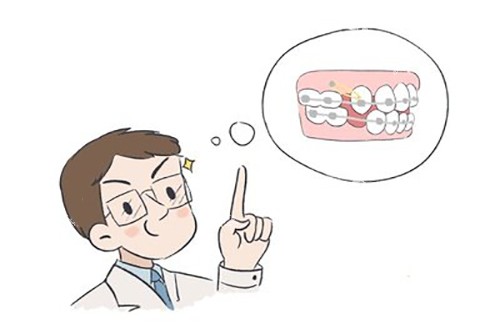 正畸收缝示意图 正畸收缝示意图