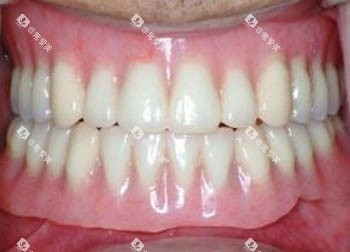 假牙照片 假牙照片