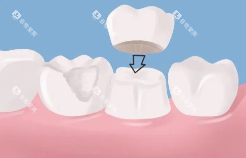 牙冠图片 牙冠图片