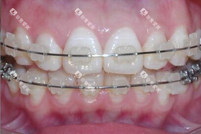 陶瓷半隐形牙套