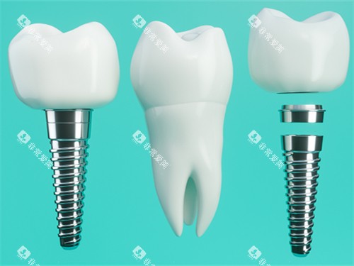 种植牙和真实牙齿漫画示意图