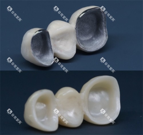 烤瓷牙和全瓷牙 烤瓷牙和全瓷牙