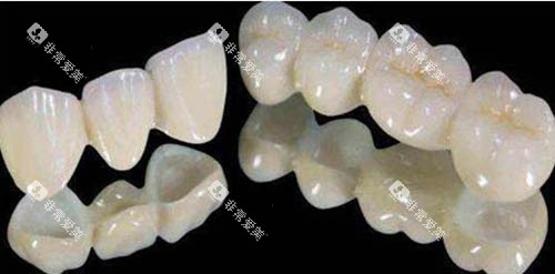全瓷牙套照片 全瓷牙套照片