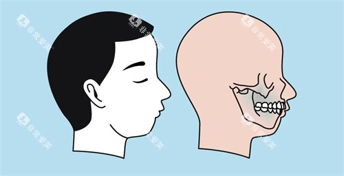 凸嘴的图片