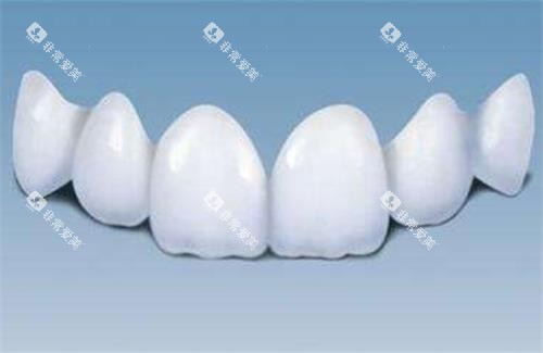 全瓷牙的示意图 全瓷牙的示意图