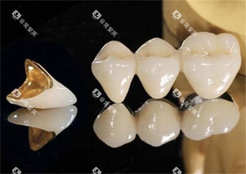 单颗烤瓷牙和连冠烤瓷牙 单颗烤瓷牙和连冠烤瓷牙