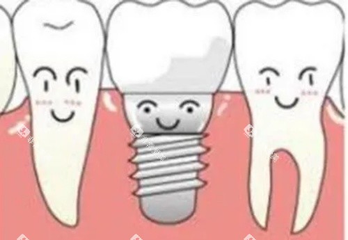 种植体种植卡通示意图 种植体种植卡通示意图