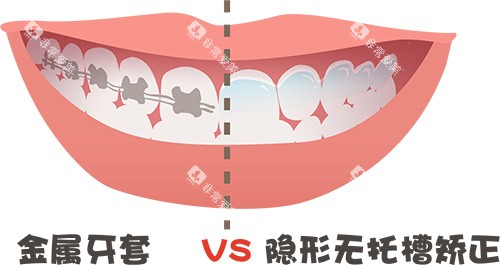 牙齿矫正牙套金属对比隐形牙套