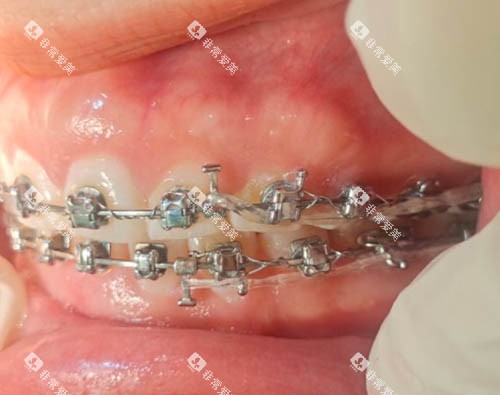 金属牙套矫正细节图